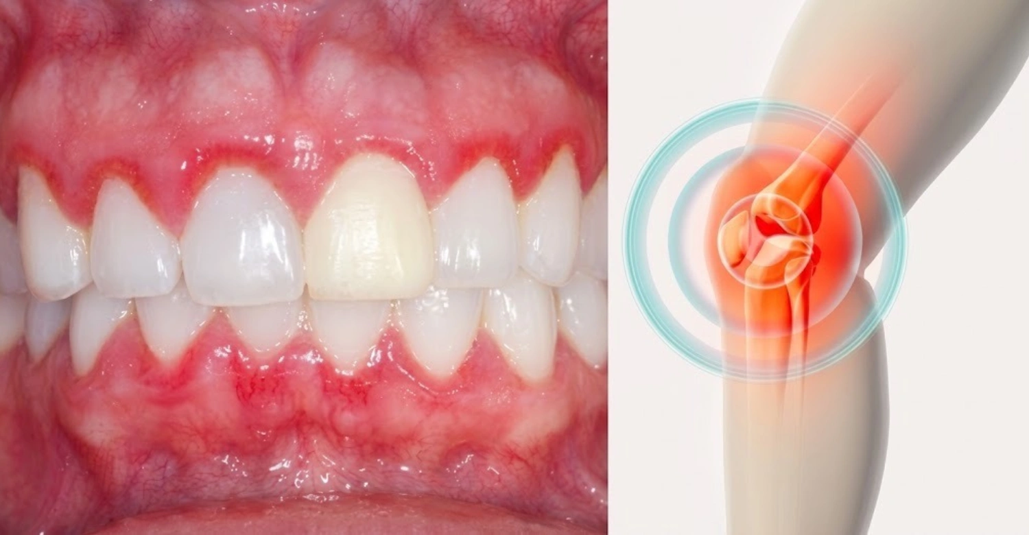 Rheumatoid arthritis tooth pain1